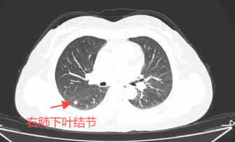 双微创！单孔胸腔镜+不插管手术，肺癌手术竟然还能这样做......